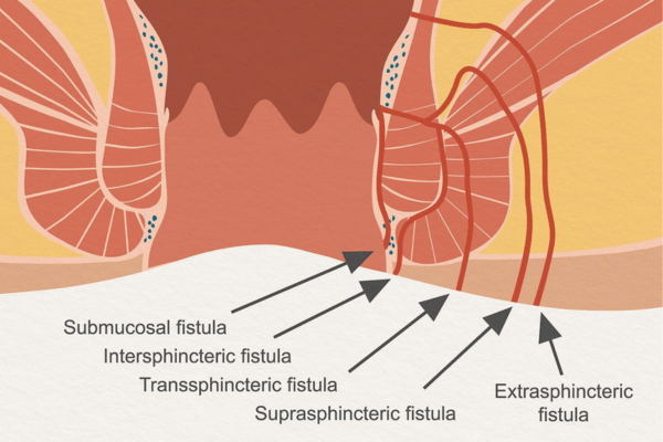 Fistula Specialist in Thrissur