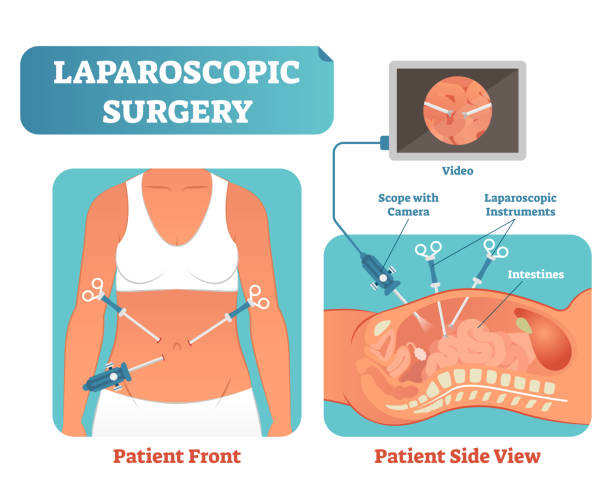 Laparoscopic Surgery information