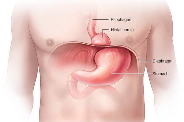 Hiatal Hernia Treatment In Thrissur_ Dr Arun Nair