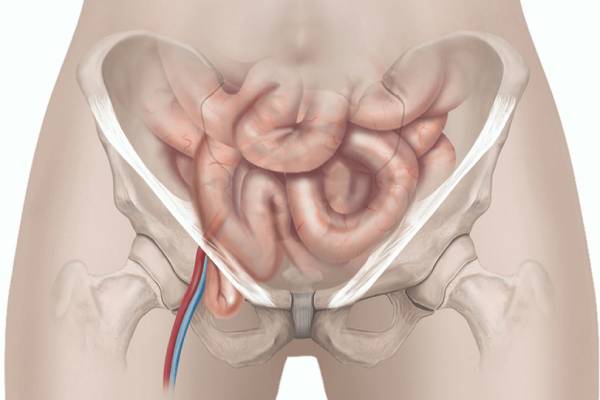 Femoral Hernia Treatment In Thrissur - Dr. Arun S. Nair