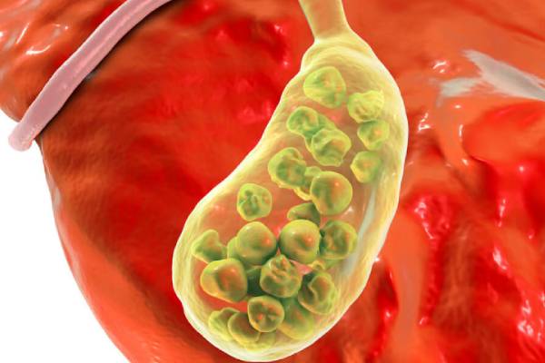 Gallbladder with multiple stones – Gallbladder Stone Treatment in Palakkad by Dr. Arun Nair