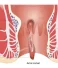 Medical illustration showing anal fissure, hemorrhoids, and sphincter anatomy used by Dr. Arun S. Nair for anal fissure treatment in Thrissur